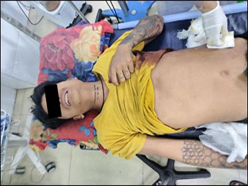 A man injured by gunfire in  near Nandar (South) Village,  Patheingyi Township of Mandalay Region. 