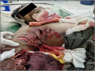 An innocent civilian sustained shrapnel injuries after triggering an explosive device planted by a so-called PDF terrorist faction in Pakokku Township of Magway Region.