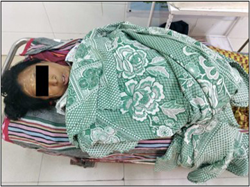 Innocent Civilian Injured in Heavy Weapon Attack by Terrorists in Tada-U Township  of Mandalay Region.