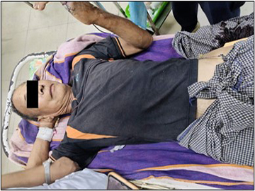 Innocent Civilian Injured in Heavy Weapon Attack by Terrorists in Natogyi Township  of Mandalay Region.