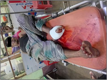  Innocent Civilian Injured After Stepping on Explosive Device Planted by Terrorist Faction  in Hpa-an Township of Kayin State.