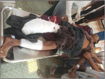 Innocent Civilian Injured After Explosion of Device Planted by So-called PDF terrorist Faction in Salin Township of Magway Region.