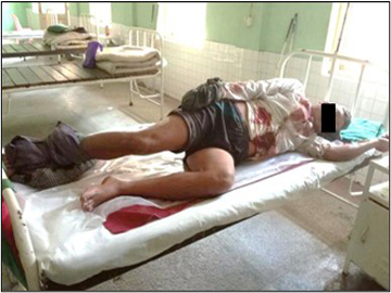    An innocent civilian was injured after stepping on an explosive device planted by a so-called PDF terrorist faction in Kale Township of Sagaing Region.