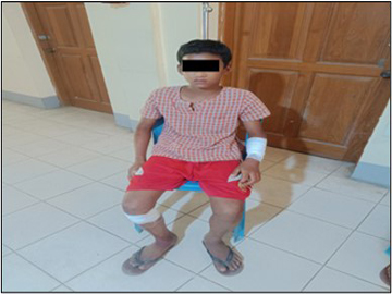 A child was injured after stepping on an explosive device planted by a so-called PDF terrorist faction in Kambalu Township of Sagaing Region.
