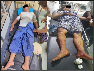 Two innocent civilians were injured in explosion device planted by a faction of pro-terrorism KNU members, along with so-called PDF terrorists in Shwegyin Township of Bago Region.