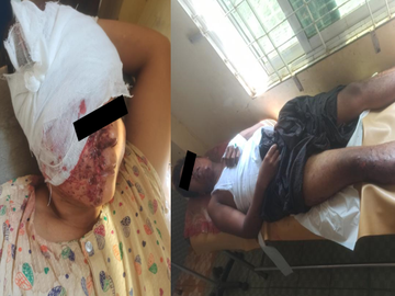 Two innocent civilians were injured after stepping on an explosive device planted by a so-called PDF terrorist faction in Salin Township of Magway Region.