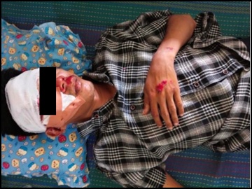 An innocent civilian was injured in a heavy weapon attack by a terrorist group in Bokepyin Township of Bago Region.