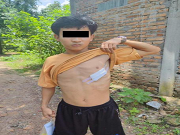 An innocent civilian was injured in an improvised rocket attack by terrorist group in Kyon Doe Town, Kawkareik Township of Kayin State.
