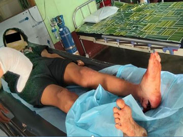 An innocent civilian injured in a heavy weapon attack by a terrorist group in Kawkareik Township of Kayin State.