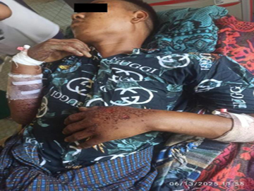 An innocent civilian was injured after stepping on an explosive device planted by a so-called PDF terrorist group in Salin Township of Magway Region.