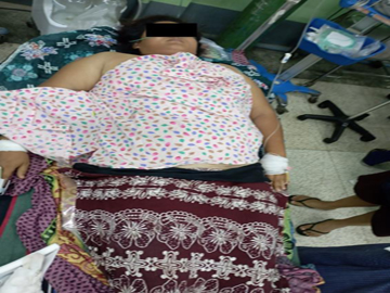 An innocent civilian injured in an attack by a so-called PDF terrorist group in Pakokku Township of Magway Region.