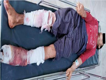An innocent civilian injured in a heavy weapon attack by a combined group of Ta’ang National Liberation Army (TNLA) Terrorist Group, along with so-called PDF terrorists in Naungcho Township of Northern Shan State.