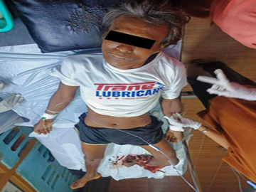 An innocent civilian injured in an improvised explosive device planted by a combined group of KIA armed insurgents and so-called PDF terrorists in Pwintphyu Twonship of Magway Region.