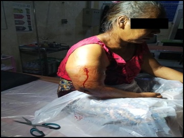 An innocent civilian injured in a heavy weapon attack by a so-called PDF terrorist group in Yebyu Township of Tanintharyi Region.