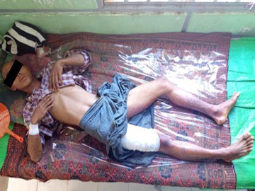 Innocent Civilian injured after stepping on a landmine planted by a so-called PDF terrorist group in Pwintphyu Township of Magway Region.