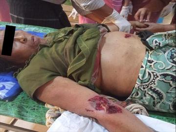 တနင်္သာရီတိုင်းဒေသကြီး၊ ပုလောမြို့နယ်၌ PDF အမည်ခံ အကြမ်းဖက်သမားများထောင်ထားသည့် မိုင်း တစ်လုံးအား နင်းမိပေါက်ကွဲခဲ့မှုကြောင့် အပြစ်မဲ့ အရပ်သားပြည်သူ တစ်ဦး ထိခိုက်ဒဏ်ရာရရှိမှု မှတ်တမ်းဓာတ်ပုံ။