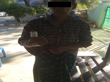 An innocent civilian injured in an attack by a so-called PDF terrorists   in Natogyi Township of Mandalay Region.