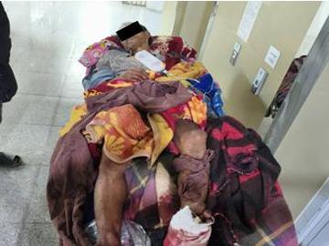 ကချင်ပြည်နယ်၊ မိုးကောင်းမြို့နယ်၌ KIA သောင်းကျန်းသူအဖွဲ့နှင့် PDF အမည်ခံ အကြမ်းဖက်  သမားများ ပူးပေါင်းအဖွဲ့ ထောင်ထားသည့် နင်းမိုင်း တစ်လုံးအား နင်းမိပေါက်ကွဲခဲ့မှုကြောင့်  အပြစ်မဲ့ အရပ်သားပြည်သူ တစ်ဦး ထိခိုက်ဒဏ်ရာရရှိမှု မှတ်တမ်းဓာတ်ပုံ။