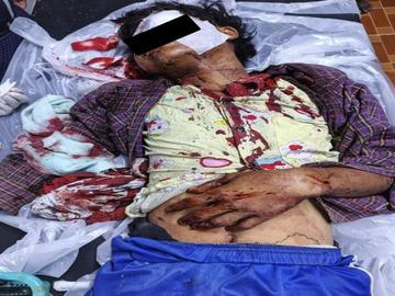 မကွေးတိုင်းဒေသကြီး၊ ပွင့်ဖြူမြို့နယ်၌ PDF အမည်ခံ အကြမ်းဖက်သမားများက သေနတ်ဖြင့်  ပစ်ခတ်ခဲ့မှုကြောင့် အပြစ်မဲ့ အရပ်သားပြည်သူ တစ်ဦး ထိခိုက်ဒဏ်ရာရရှိမှု မှတ်တမ်းဓာတ်ပုံ။