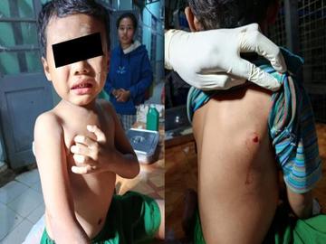 A child injured in a heavy weapon attack by so-called PDF terrorists in Gyobingauk Township of Bago Region.