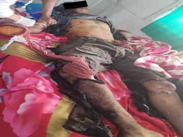 An innocent civilian injured after stepping on a landmine planted by   Ta'ang National Liberation Army (TNLA) terrorists in Naungcho Township of Shan State.