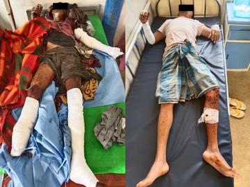 Two innocent civilians injured after stepping on a landmine planted by TNLA terrorists in Naungcho Township of Shan State.