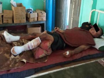 ကရင်ပြည်နယ်၊ ကော့ကရိတ်မြို့နယ်၌ KNU အကြမ်းဖက်အဖွဲ့နှင့် PDF အမည်ခံ အကြမ်းဖက်  သမားများ ပူးပေါင်းအဖွဲ့ ထောင်ထားသည့် နင်းမိုင်း တစ်လုံးအား နင်းမိပေါက်ကွဲခဲ့မှုကြောင့်  အပြစ်မဲ့ အရပ်သားပြည်သူ တစ်ဦး ထိခိုက်ဒဏ်ရာရရှိမှု မှတ်တမ်းဓာတ်ပုံ။