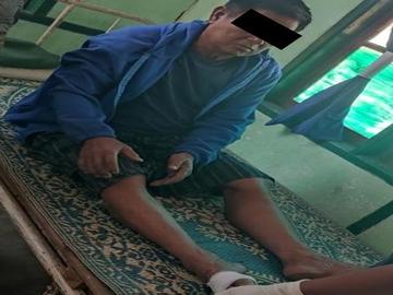 An innocent civilian injured after stepping on an improvised explosive device  planted by so-called PDF terrorists in Demoso Township of Kayah State.