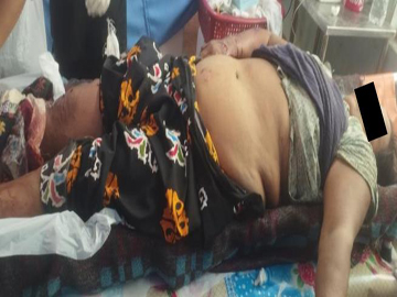 မန္တလေးတိုင်းဒေသကြီး၊ မတ္တရာမြို့နယ်၌ PDF အမည်ခံ အကြမ်းဖက်သမားများ ထောင်ထားသည့် နင်းမိုင်း တစ်လုံးအား နင်းမိပေါက်ကွဲခဲ့မှုကြောင့် အပြစ်မဲ့ အရပ်သားပြည်သူ တစ်ဦး ထိခိုက်ဒဏ်ရာရရှိမှု မှတ်တမ်းဓာတ်ပုံ။