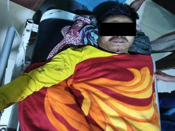 An innocent civilian injured after stepping on an improvised explosive device planted by TNLA terrorists in Naungcho Township of Shan State.