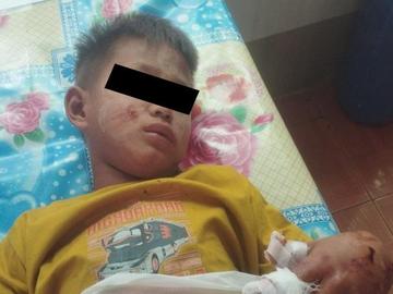 A child injured in an improvised explosive device explosion planted  by so-called PDF terrorists in Madaya Township.