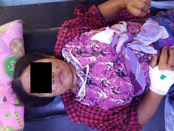 An innocent civilian injured in an improvised explosive device explosion planted by so-called PDF terrorists in Pwintphyu Township of Magway Region.