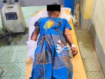 An innocent civilian injured in an improvised explosive device explosion planted by so-called PDF terrorists in Salin Township of Magway Region.