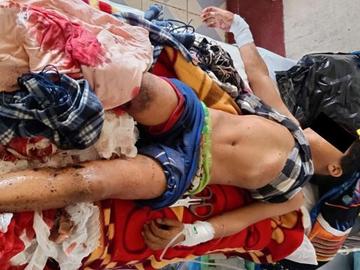 Child injured in explosion of an unexploded hand grenade left by the CDF terrorists in Falam Township of Chin State.