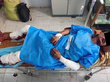 An innocent civilian injured in an improvised explosive device explosion planted by so-called PDF terrorists in Loikaw Township of Kayah State.