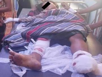 မကွေးတိုင်းဒေသကြီး၊ ပွင့်ဖြူမြို့နယ်၌ PDF အမည်ခံ အကြမ်းဖက်သမားများ ထောင်ထားသည့်  နင်းမိုင်း တစ်လုံးအား နင်းမိ ပေါက်ကွဲခဲ့မှုကြောင့် အပြစ်မဲ့ အရပ်သားပြည်သူ တစ်ဦး ထိခိုက်ဒဏ်ရာရရှိမှု မှတ်တမ်းဓာတ်ပုံ။