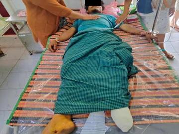An innoent civilian injured in an improvised explosive device explosion planted by so-called PDF terrorists in Dawei Township of Tanintharyi Region.