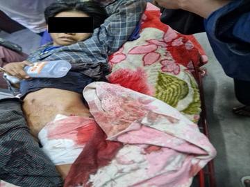 A child injured in a heavy weapon attack by so-called PDF terrorists in Htigyaing Township of Sagaing Region.