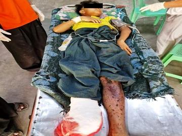 An innocent civilian injured after stepping on an improvised explosive device planted by so-called PDF terrorists in Natogyi Township of Mandalay Region.