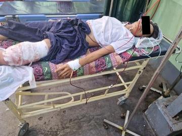 An innocent civilian injured in a heavy weapon attack by so-called PDF terrorists in Myaung Township of Sagaing Region.