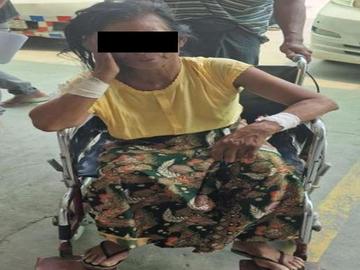 An innocent civilian injured in a heavy weapon attack by so-called PDF terrorists in Monywa Township of Sagaing Region.