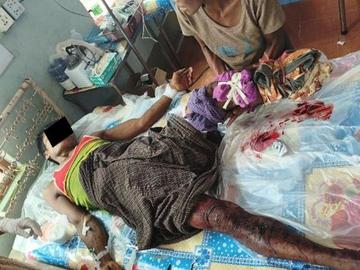 မန္တလေးတိုင်းဒေသကြီး၊ မတ္တရာမြို့နယ်၌ PDF အမည်ခံ အကြမ်းဖက်သမားများ ထောင်ထားသည့် နင်းမိုင်း တစ်လုံးအား နင်းမိပေါက်ကွဲခဲ့မှုကြောင့် အပြစ်မဲ့ အရပ်သားပြည်သူ တစ်ဦး ထိခိုက်ဒဏ်ရာရရှိမှု မှတ်တမ်းဓာတ်ပုံ။