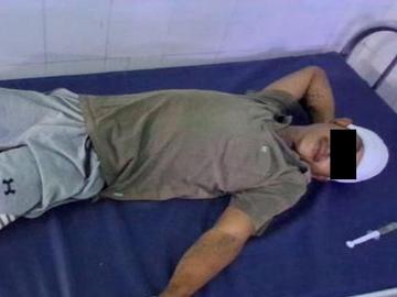 An innocent civilian injured in a heavy weapon attack by so-called PDF terrorists in Nyaunglebin Township of Bago Region.