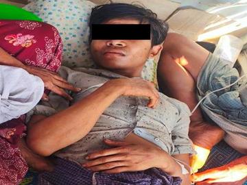 An innocent civilian injured in an improvised explosive device explosion in Yebyu Township of Tanintharyi Region.