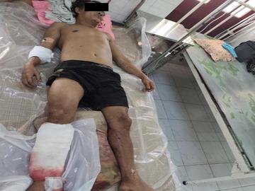 An innocent civilian injured in an improvised explosive device explosion in Dawei Township of Tanintharyi Region.