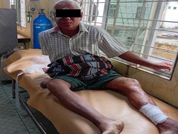 An innocent civilian injured in an improvised explosive device explosion in Salin Township of Magway Region.
