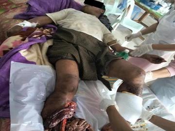 An innocent civilian injured in an improvised explosive device planted by the TNLA terrorist group in Naungcho Township of Shan State.