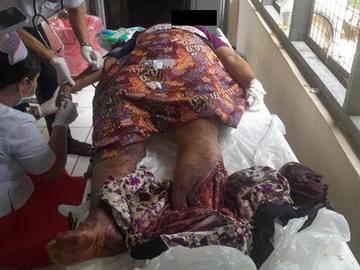 An innocent civilian injured in an improvised explosive device explosion in Kyaukgyi Township of Bago Region.